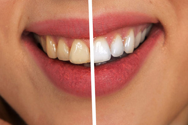 Teeth Whitening in Edmond, OK