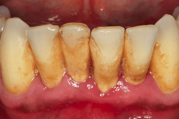 Periodontitis Procedure Periodontitis Procedure in Edmond, OK