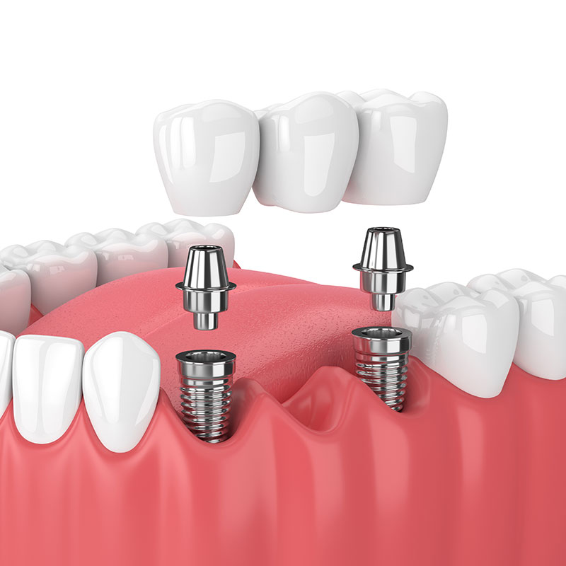 Dental Bridge