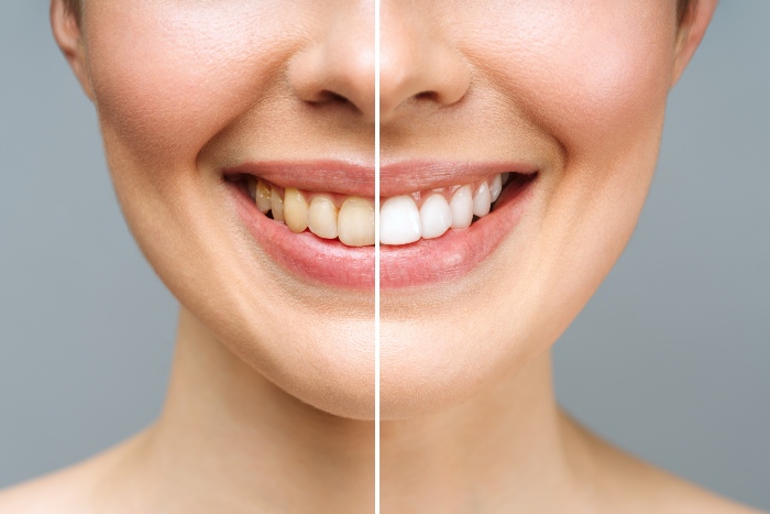 Teeth Whitening Service in Edmond & Midwest City, OK