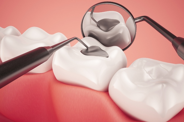 Dental Filling Procedures in Edmond, OK